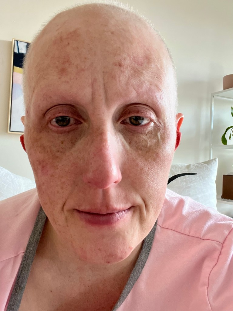 Jana 2021 bald headed after multiple rounds of chemotherapy 